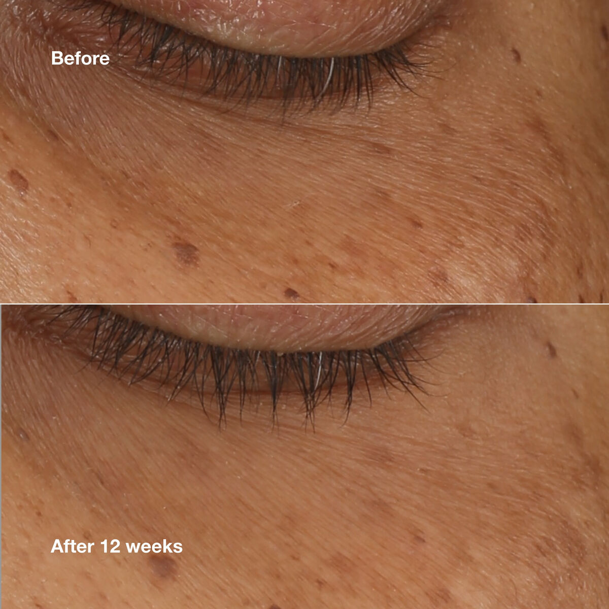 Before and after comparison of skin treatment effectiveness, showing improvement after 12 weeks.