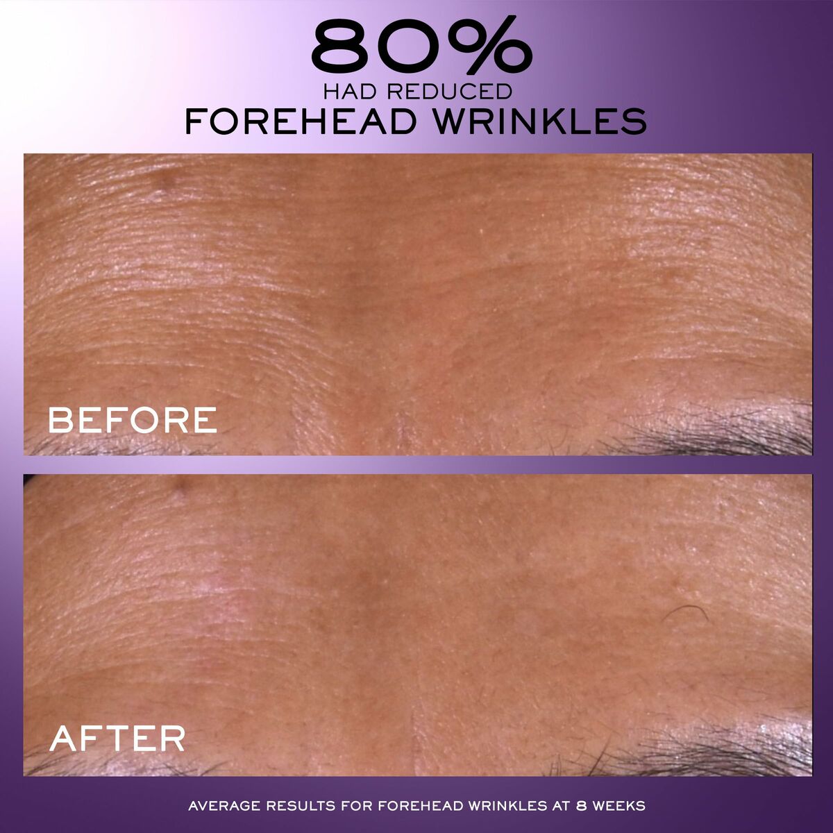 Comparison image showing forehead wrinkles before and after treatment, demonstrating 80% reduction in 8 weeks.