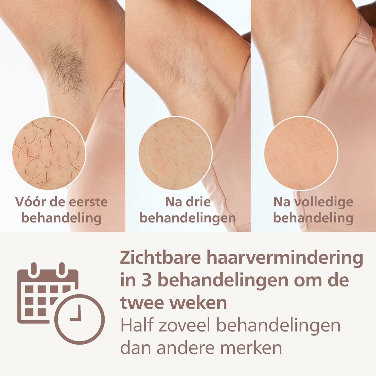 Comparative results of hair reduction with Philips BRI946/00 after 1, 3, and complete treatments.